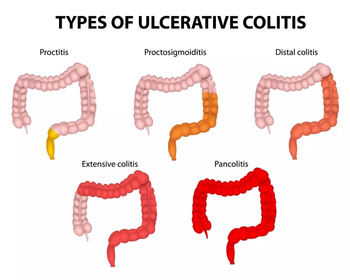 What cold medicine can i take with ulcerative colitis
