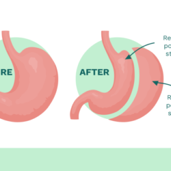 Bariatric gastric much surgery hear wls