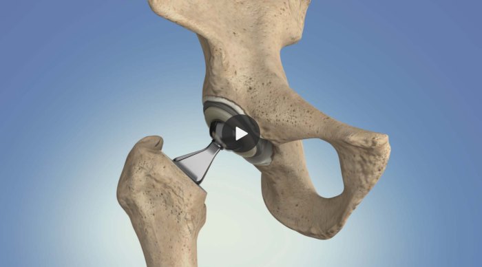 What i wish i knew before hip replacement surgery