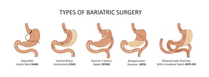 Bariatric surgery know works does work healthcare