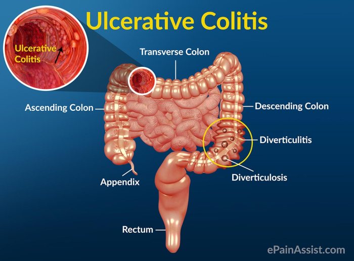 Colitis ulcerative symptoms treatment disease colon causes crohn pain ulcerosa intestine caused signs area ayurvedic diagnosis understanding ayurveda abdominal crohns