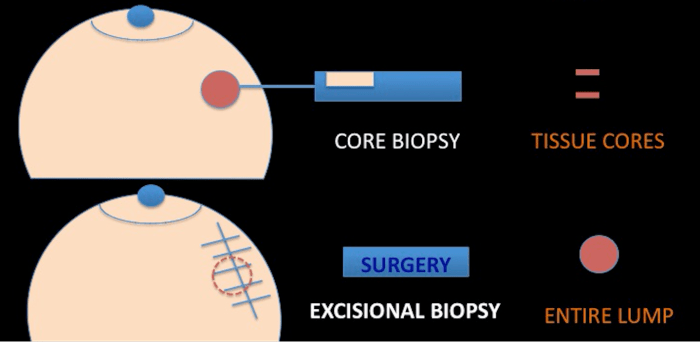 How much does a core needle breast biopsy cost