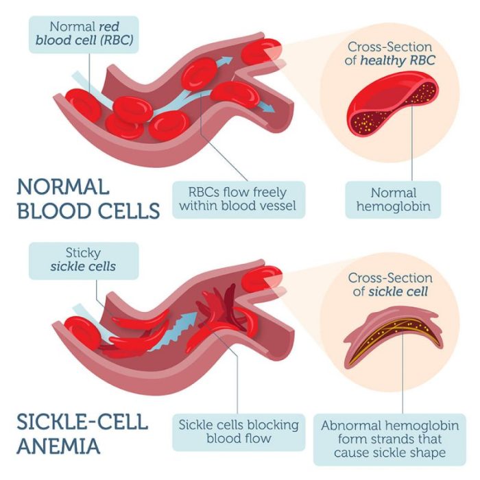 Sickle anemia dnaaccesslab