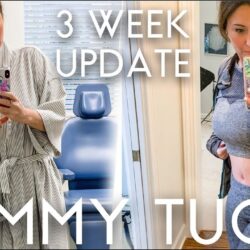 Mini tummy tuck results before after