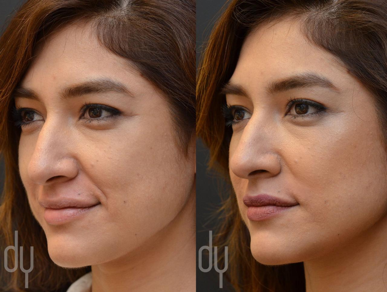 Nasolabial fold filler before and after