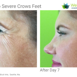 Botox for crows feet before and after