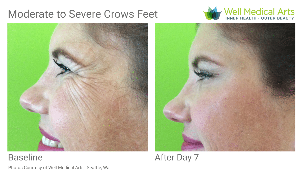 Botox for crows feet before and after