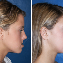 Jaw reduction surgery before and after