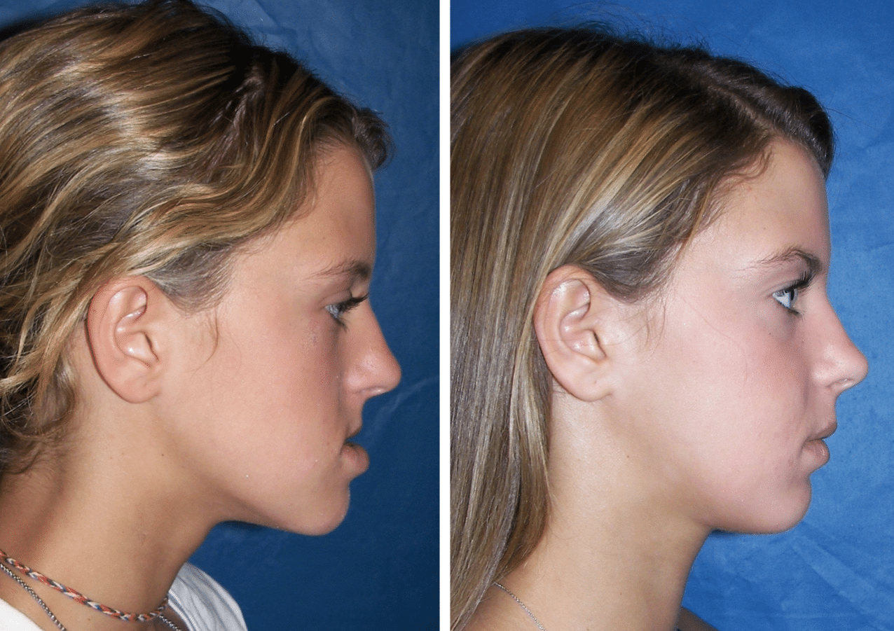 Jaw reduction surgery before and after