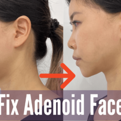 Before and after adenoid face