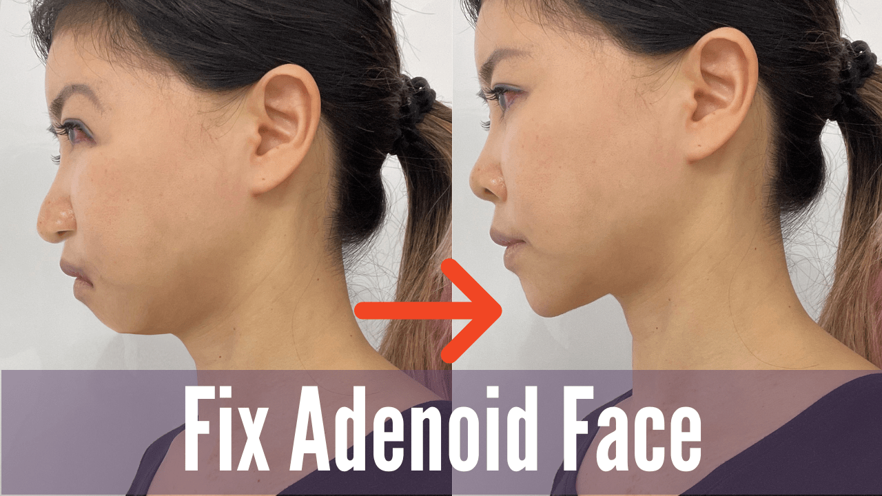 Before and after adenoid face