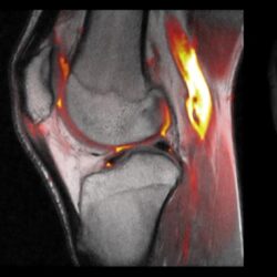 Patellar tendonitis tendinitis knee jumper jumpers ebraheim nabil everything dr need know