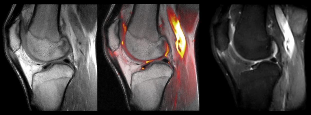 Patellar tendonitis tendinitis knee jumper jumpers ebraheim nabil everything dr need know