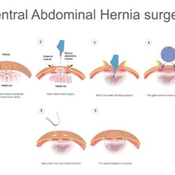 Ventral hernia repair before and after pictures