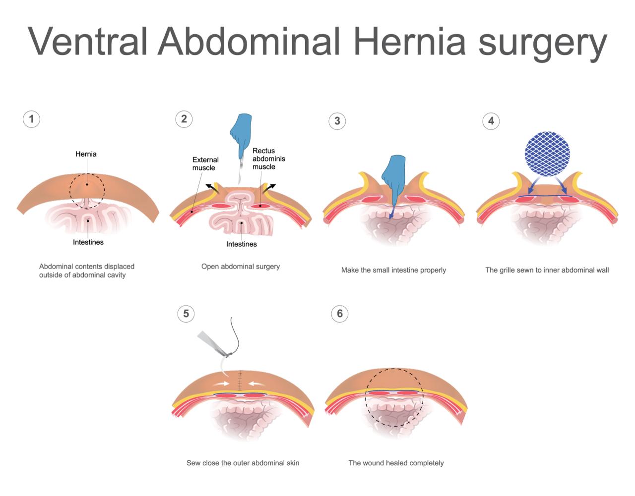 Ventral hernia repair before and after pictures