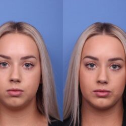 Chin augmentation before and after