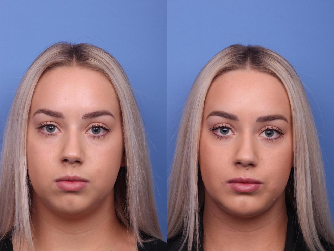 Chin augmentation before and after