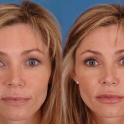 Face fillers before and after