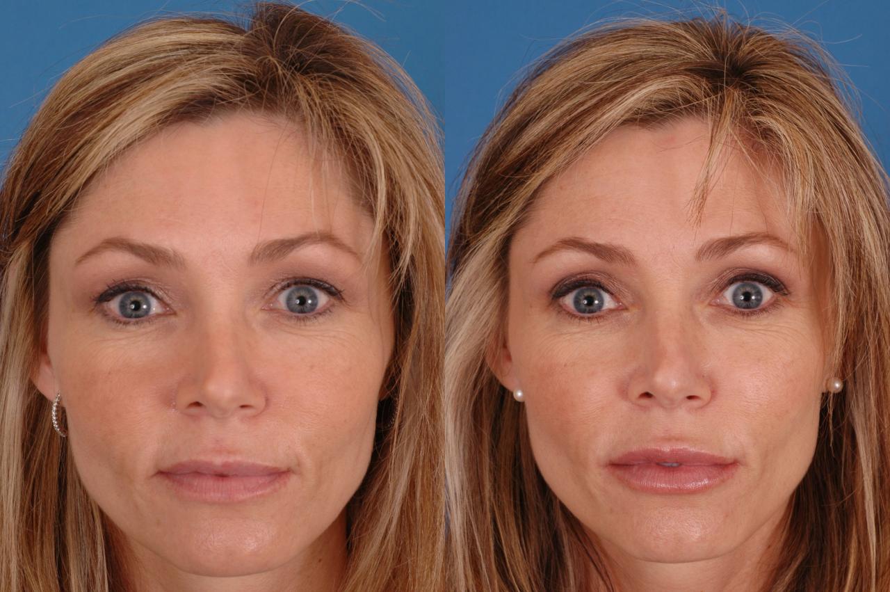 Face fillers before and after