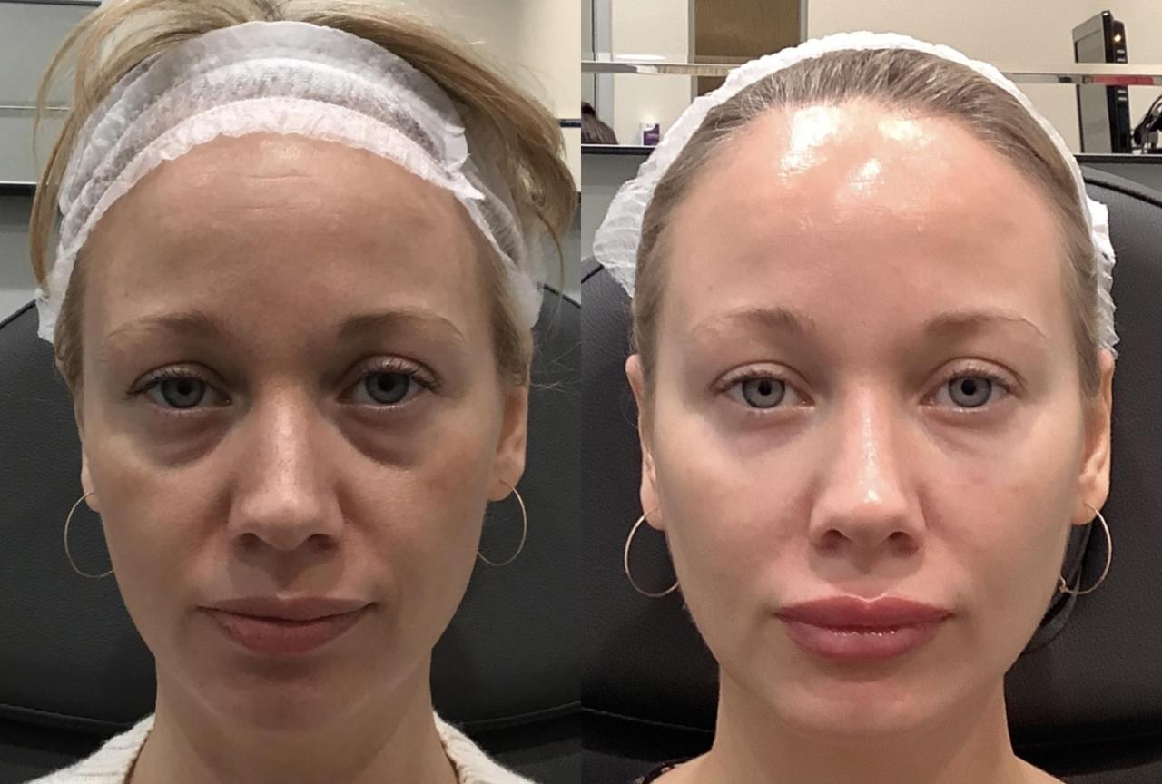 Face fillers before and after