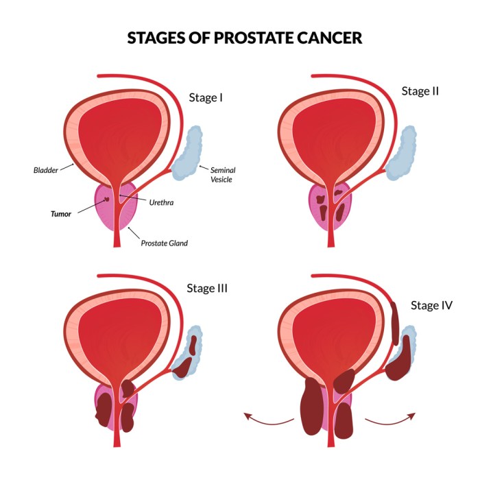 Breakthrough prostate cancer