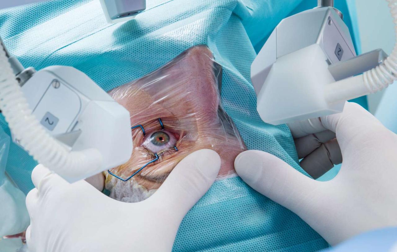 Training eyes after cataract surgery