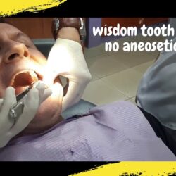 How bad is wisdom teeth removal without anesthesia