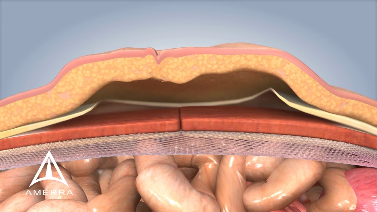 Ventral hernia repair before and after pictures