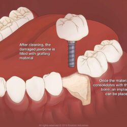 Bone graft before and after