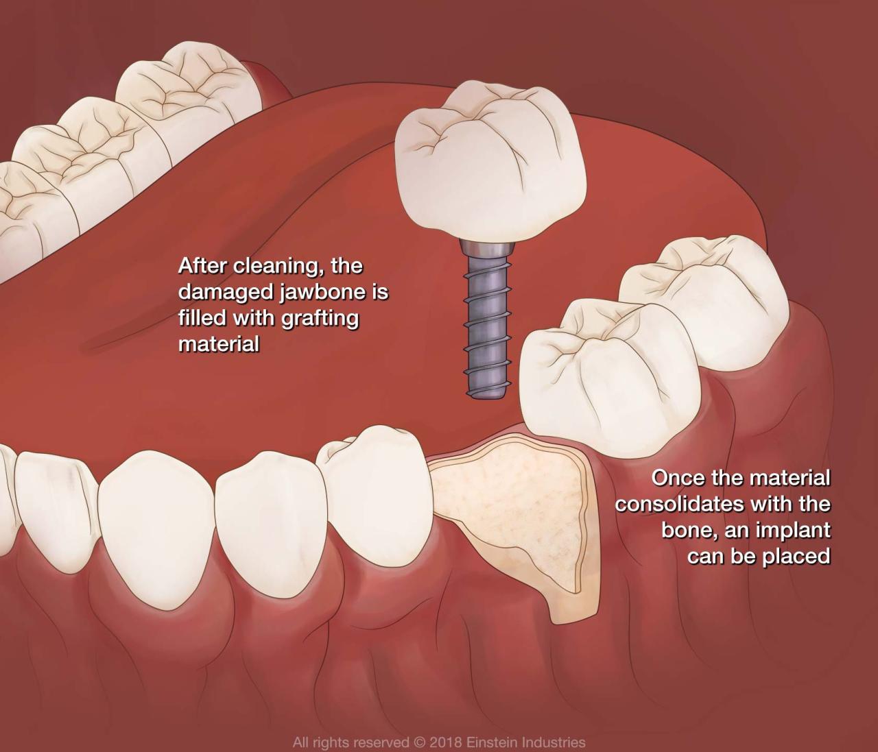 Bone graft before and after