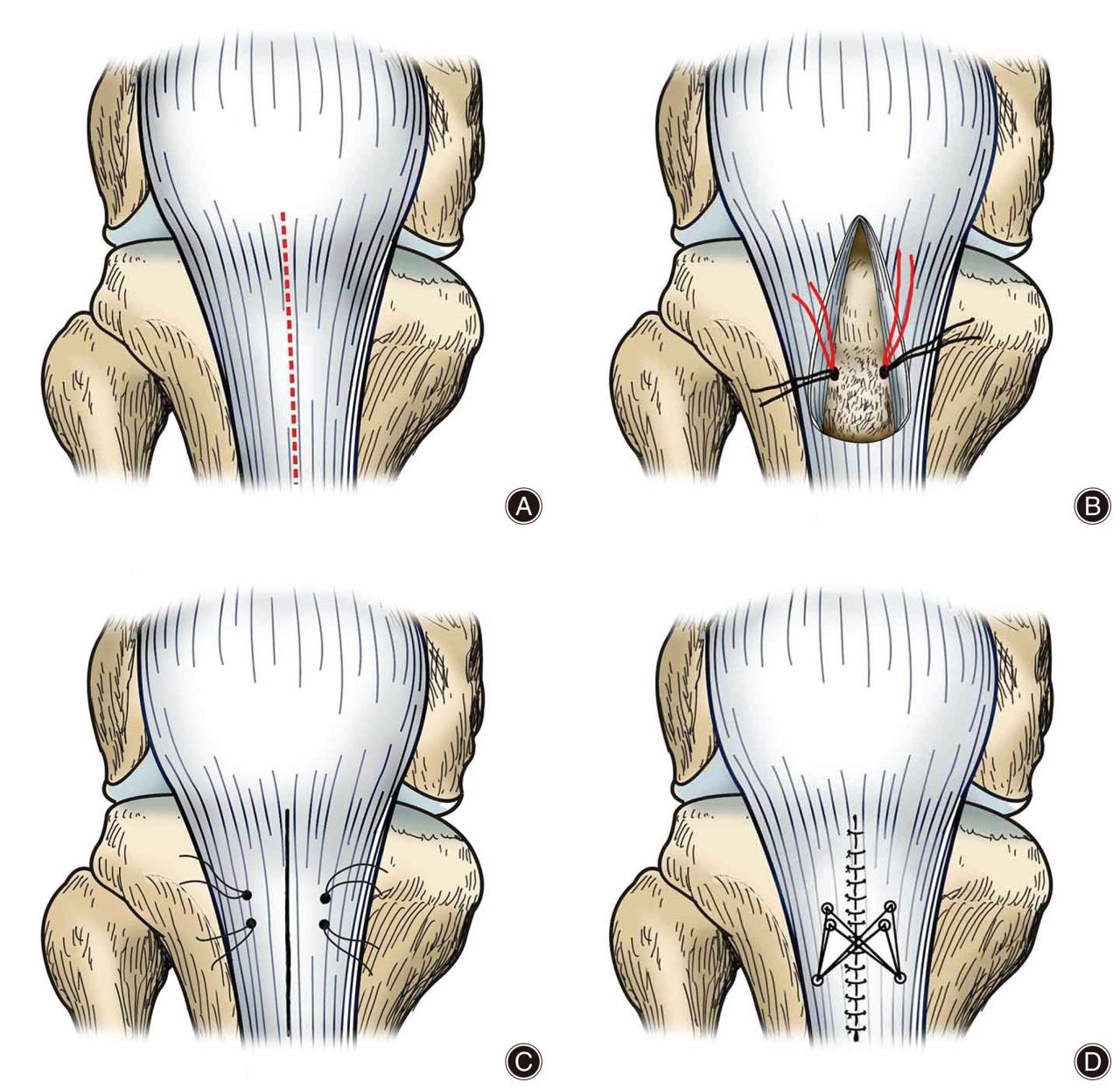 Cpt code for patellar tendon repair