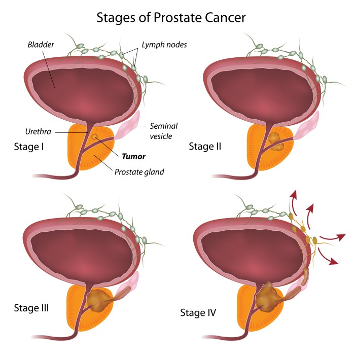 What is the best treatment for extracapsular extension prostate cancer