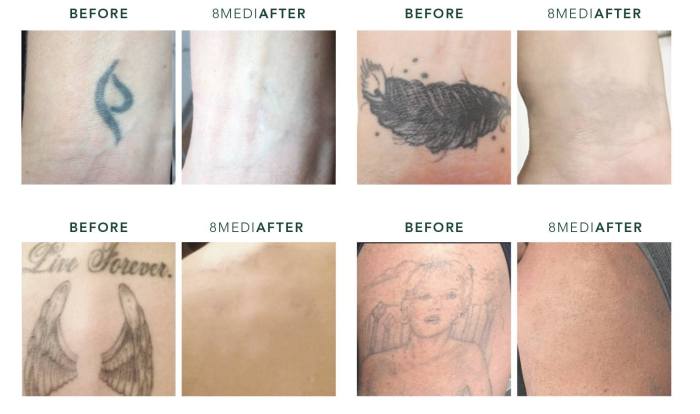 Can you have laser hair removal over a tattoo