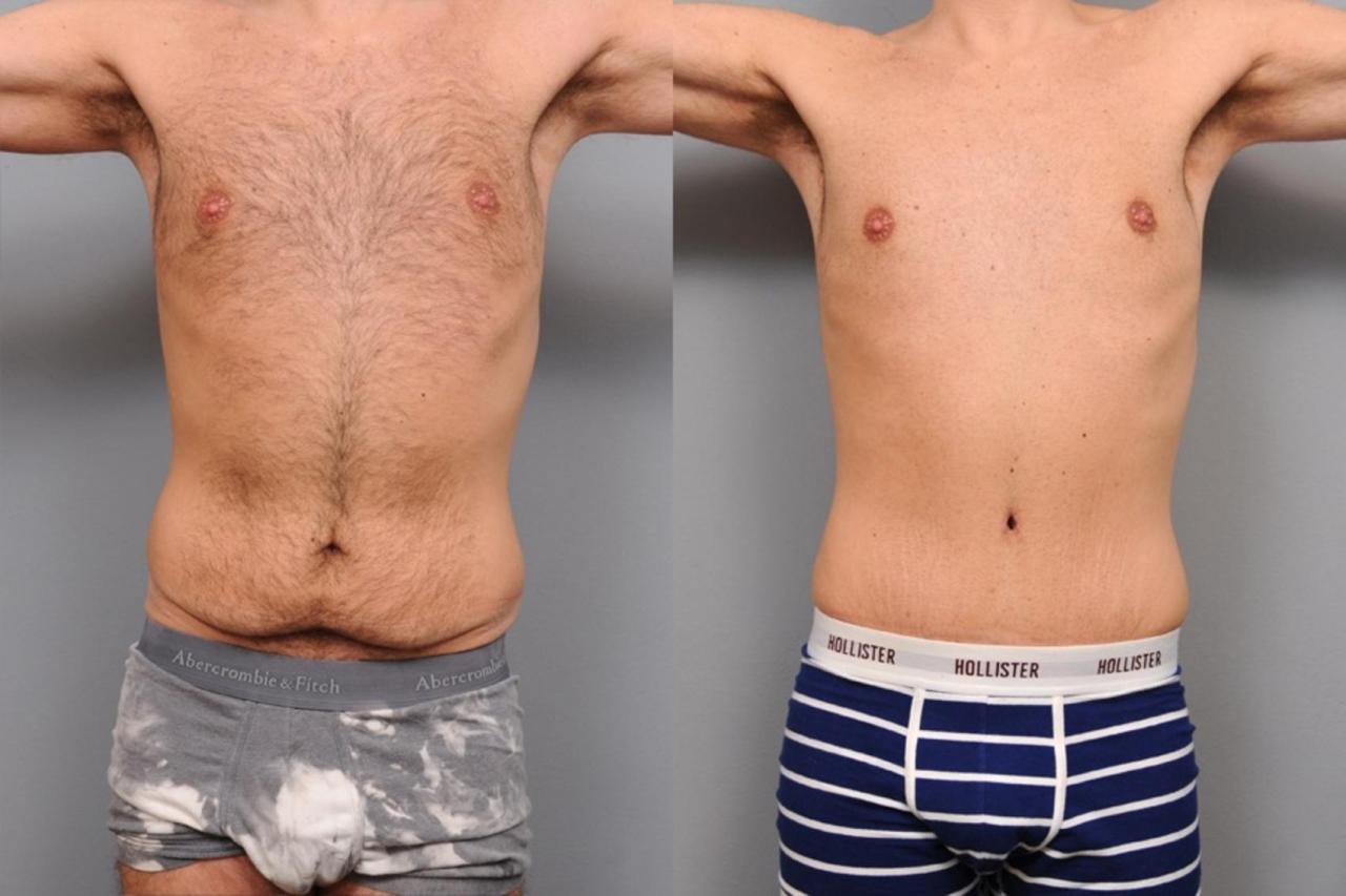 Mini tummy tuck results before after