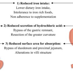 What anti inflammatory can i take after gastric bypass