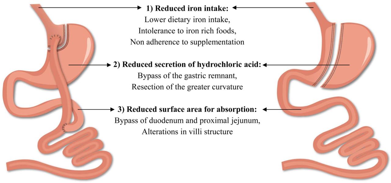 What anti inflammatory can i take after gastric bypass